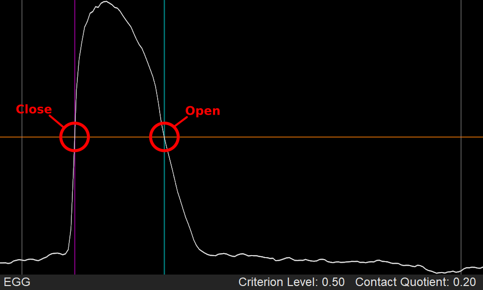 Using Criterion Level at 50% for estimating glottal contact period