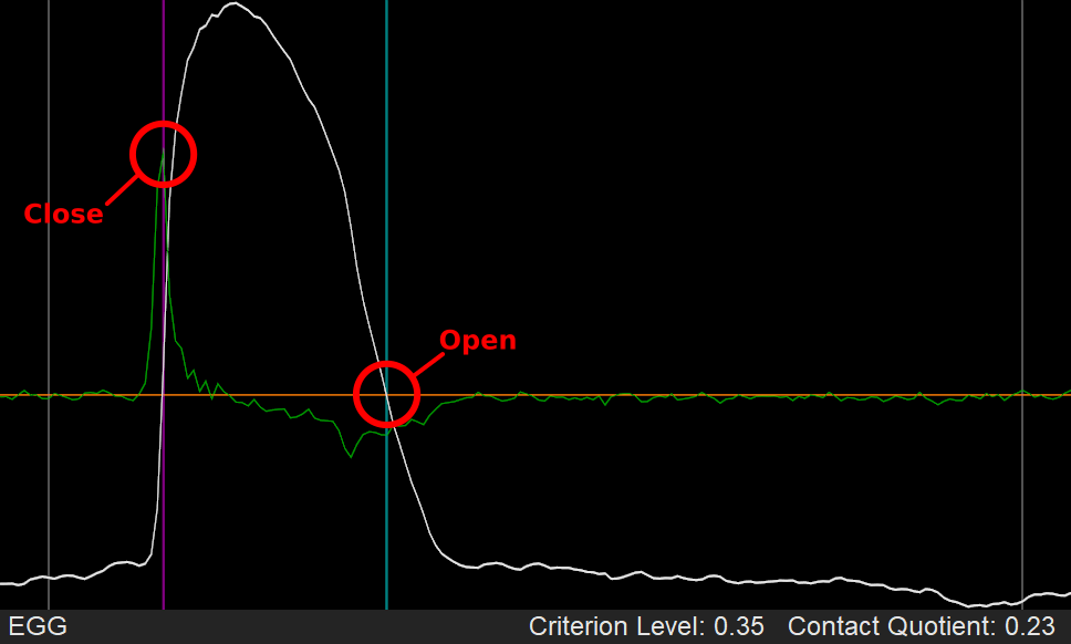 Using dEGG max for glottal closure, and Criterion Level at 35% for estimating glottal opening